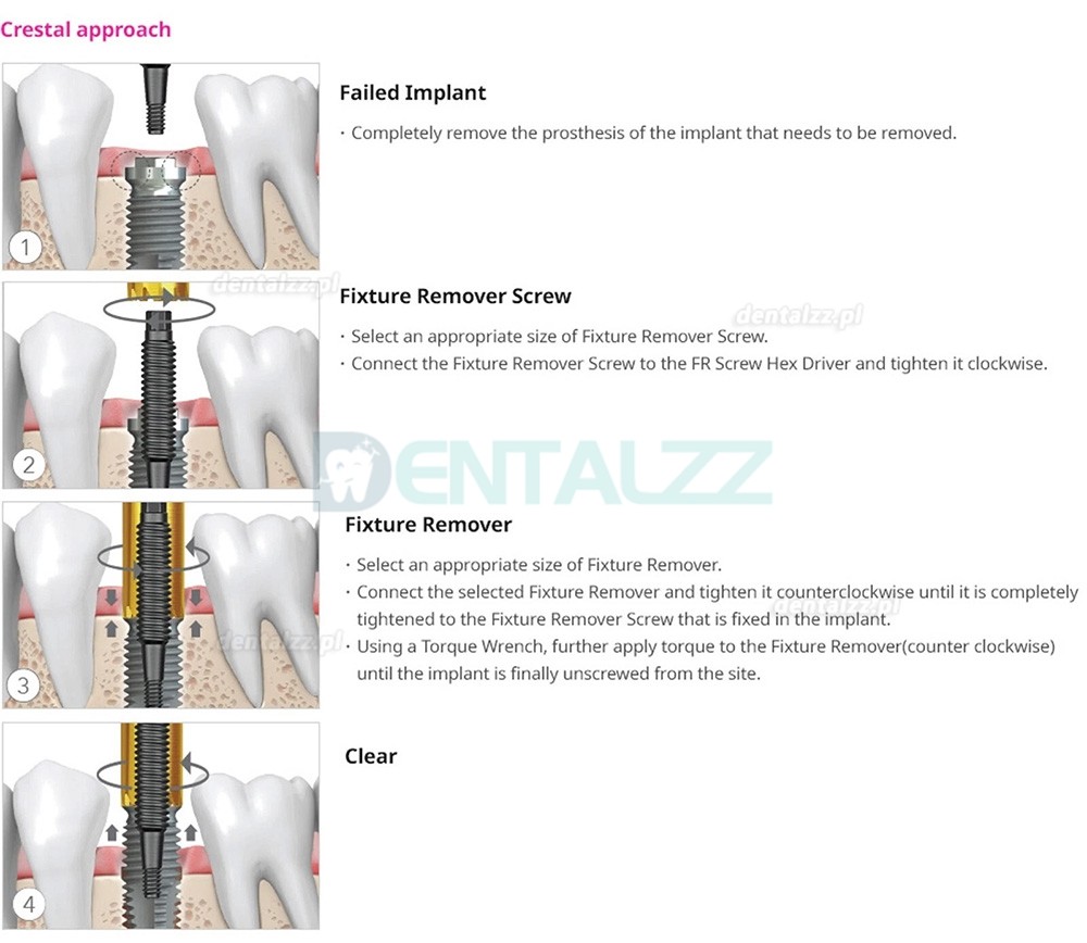 Zestaw Usuwania Implant&oacute;w z Kluczem Dynamometrycznym i Grzechotką